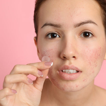 AcneOff - Onzichtbare acne-verwijderende puistjespleister